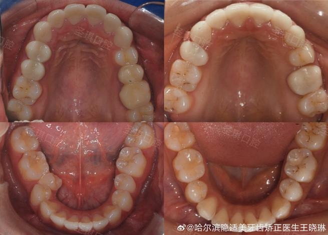 口腔科下颌骨正畸-图3