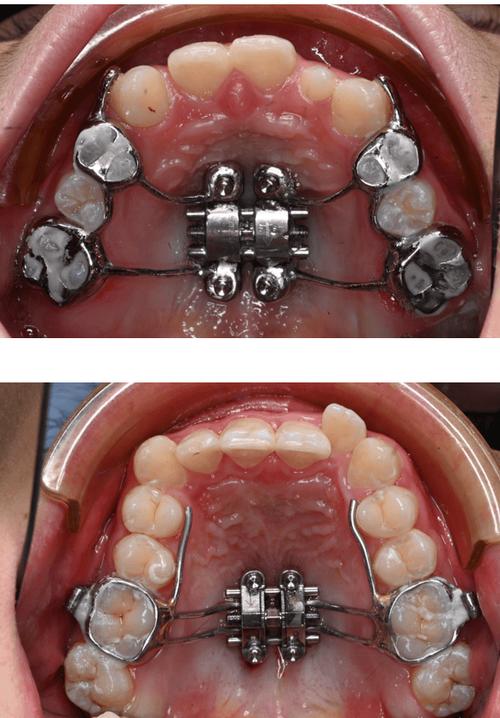 正畸辅弓拉弓外牙-图2