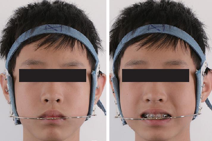 正畸辅弓拉弓外牙-图3