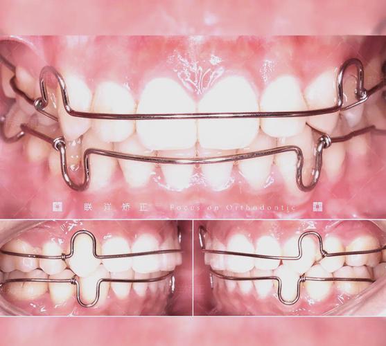 定制的正畸保持器-图2 定制的正畸保持器-图2