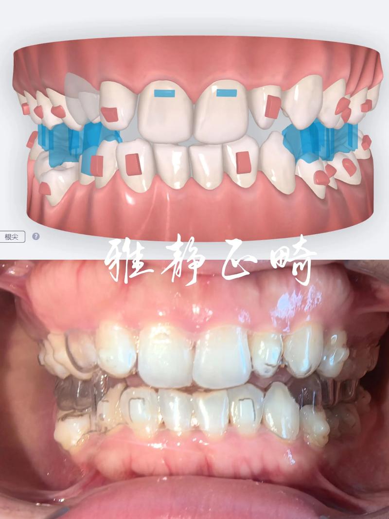 国产隐正畸怎么样-图1