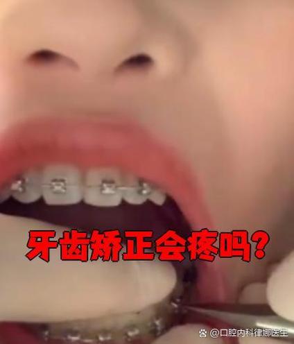 正畸固定期间疼吗-图2