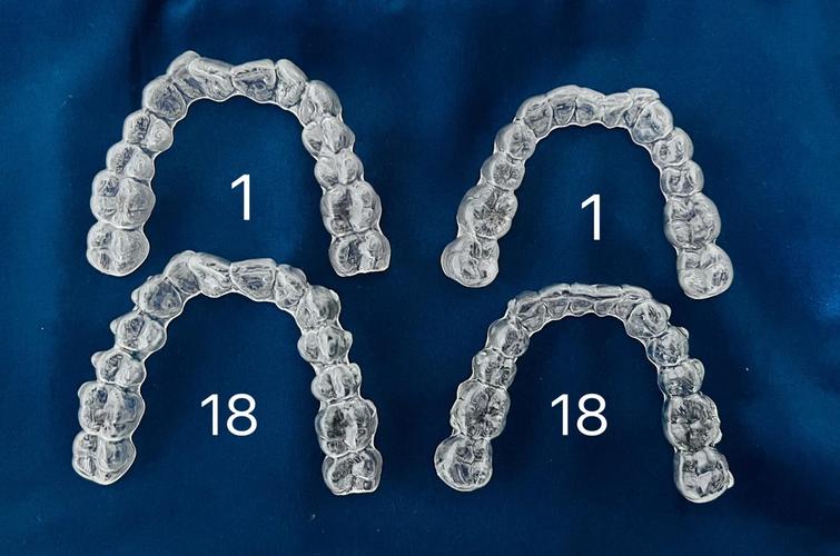 隐适美正畸57付，矫正效果能达标吗？-图2