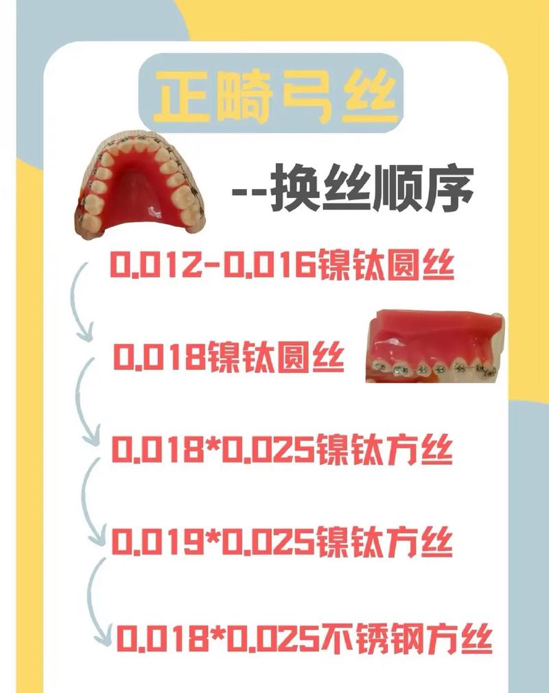 正畸扎丝选几号?型号选择有讲究吗?-图1 正畸扎丝选几号?型号选择有讲究吗?-图1