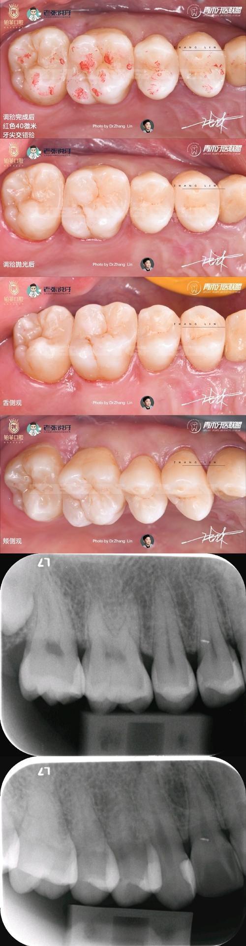 邻面去釉正畸效果如何？安全性与持久性怎么样？-图1