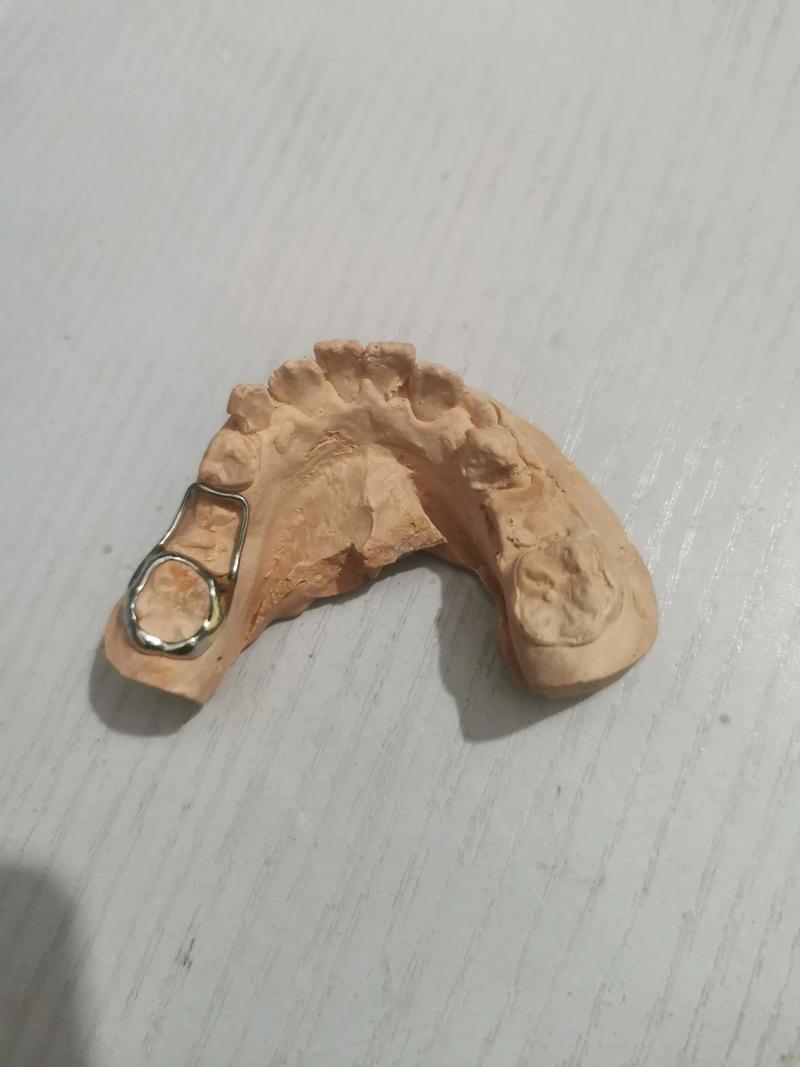 正畸保持器为啥总难摘？原因可能出在这-图2