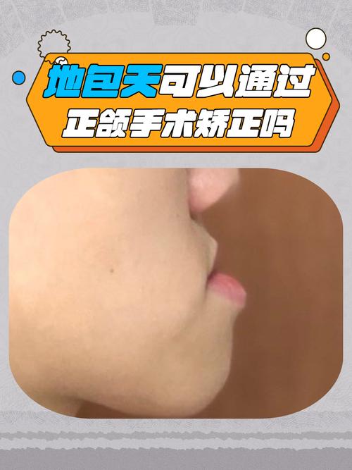 正畸形结束再正颌-图1