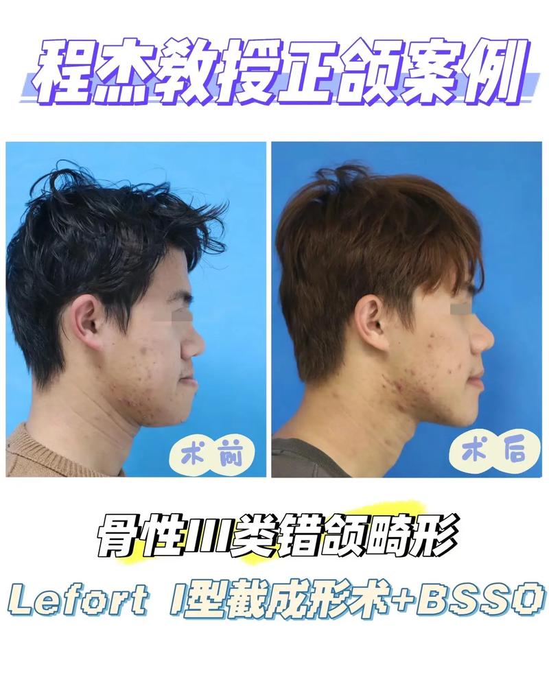 正畸形结束再正颌-图2