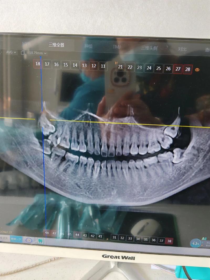 正畸拔下颌2号牙-图2