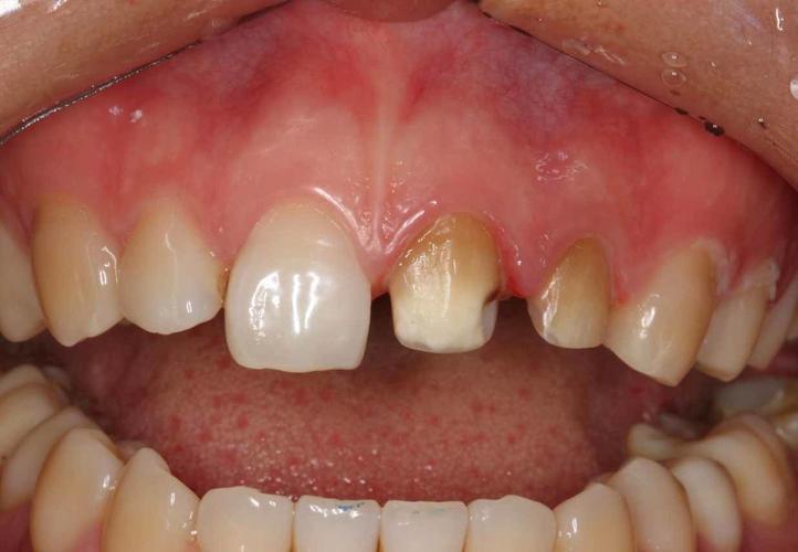 死髓牙不能正畸么-图1 死髓牙不能正畸么-图1