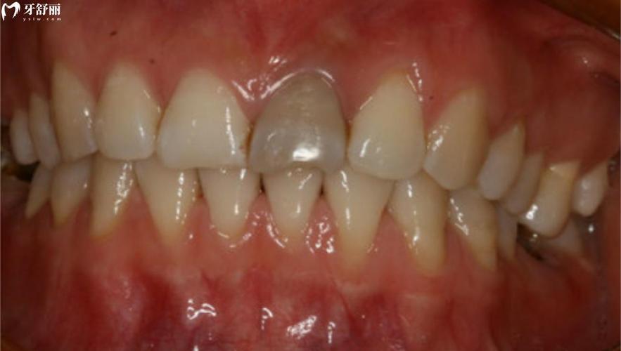 死髓牙不能正畸么-图2 死髓牙不能正畸么-图2