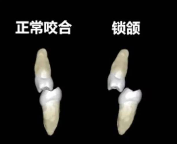 锁合不好不想正畸-图2 锁合不好不想正畸-图2
