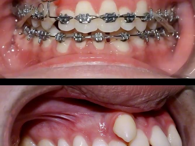 正畸牵引导致牙歪-图2