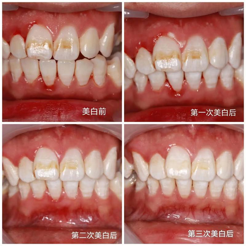 氟斑牙可以正畸嘛-图1