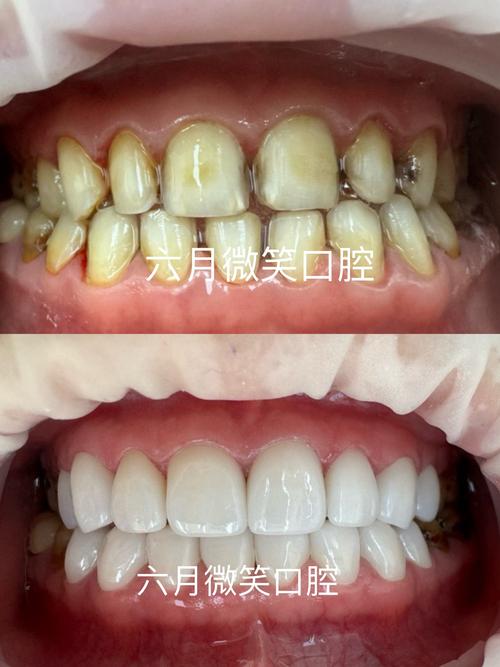 氟斑牙可以正畸嘛-图2