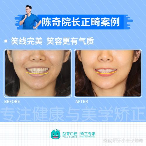 颌面正畸有风险吗-图2