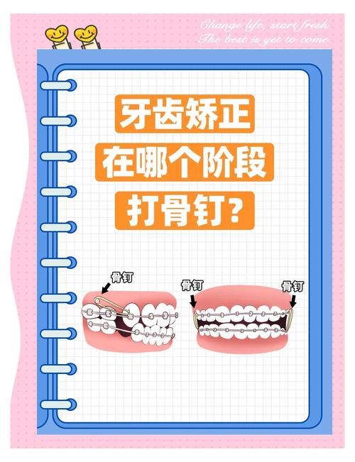 取正畸种植钉疼吗-图3