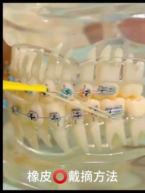 正畸橡皮链不对称为何出现？如何调整不影响矫正效果？-图1