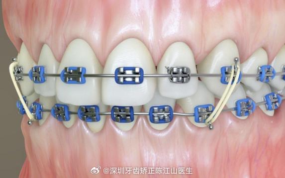 正畸弹簧上橡皮筋的正确使用方法和注意事项是什么？-图1