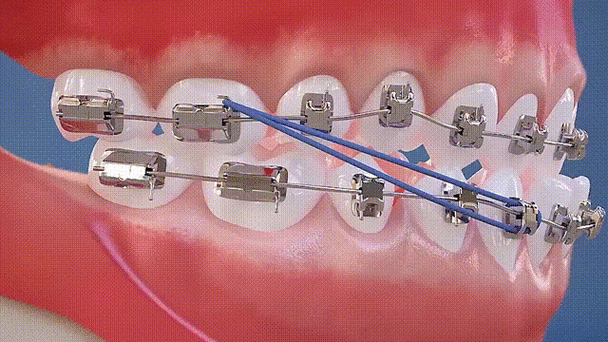正畸弹簧上橡皮筋的正确使用方法和注意事项是什么？-图2