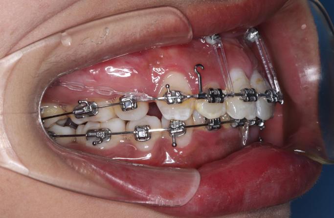 二次正畸牙根吸收-图2 二次正畸牙根吸收-图2