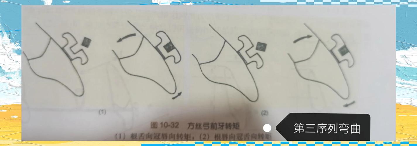 正畸正转矩的弯制-图1