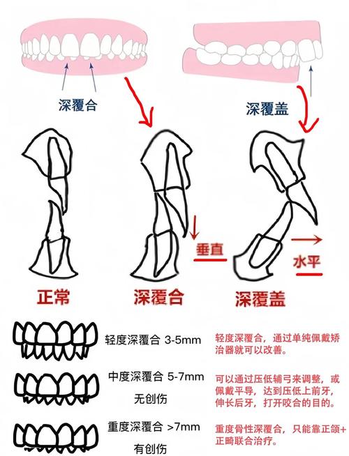 正畸深覆颌的分类-图1