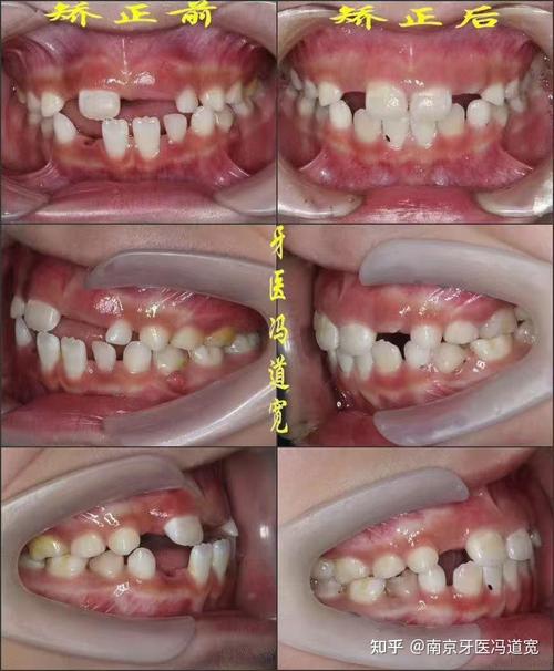 正畸过程中不适感因何而来？如何科学缓解才能更舒适？-图1