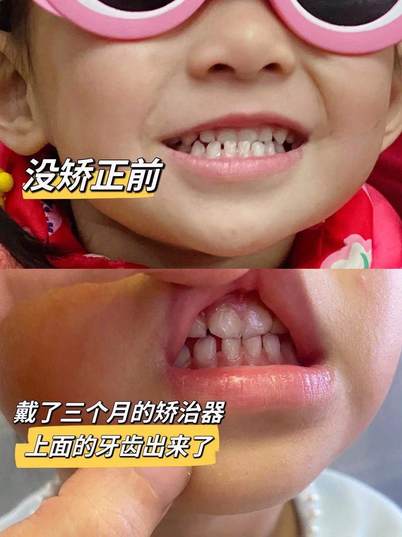 口腔儿童反颌正畸-图1