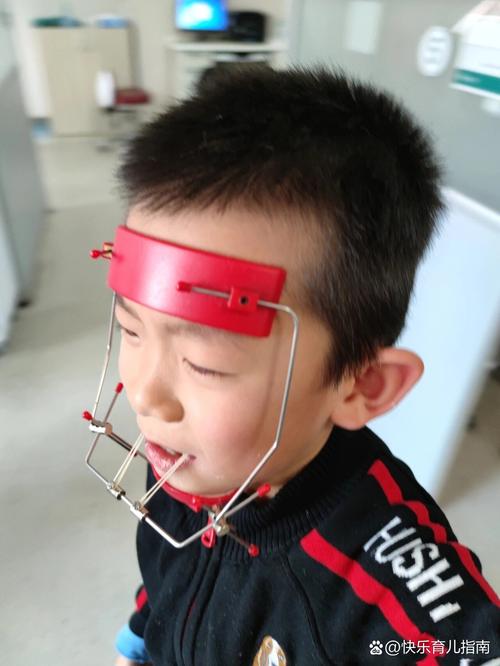 口腔儿童反颌正畸-图3