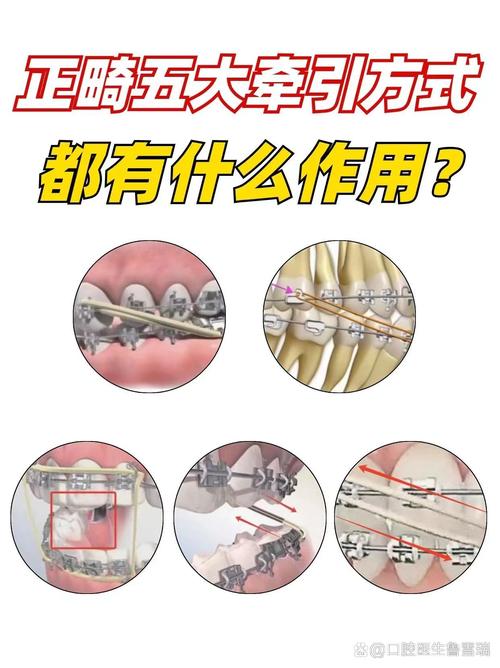 正畸丝弯环在牙齿矫正中有哪些关键作用？-图3