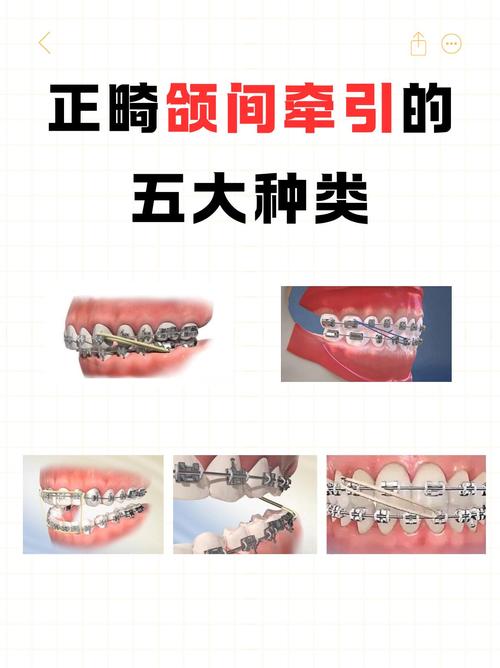 正畸3类牵引作用-图3