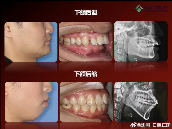 重度骨性后缩正畸-图2