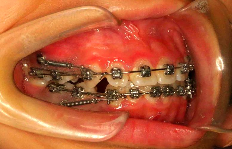 二次正畸必用种植钉吗？作用与风险解析-图1