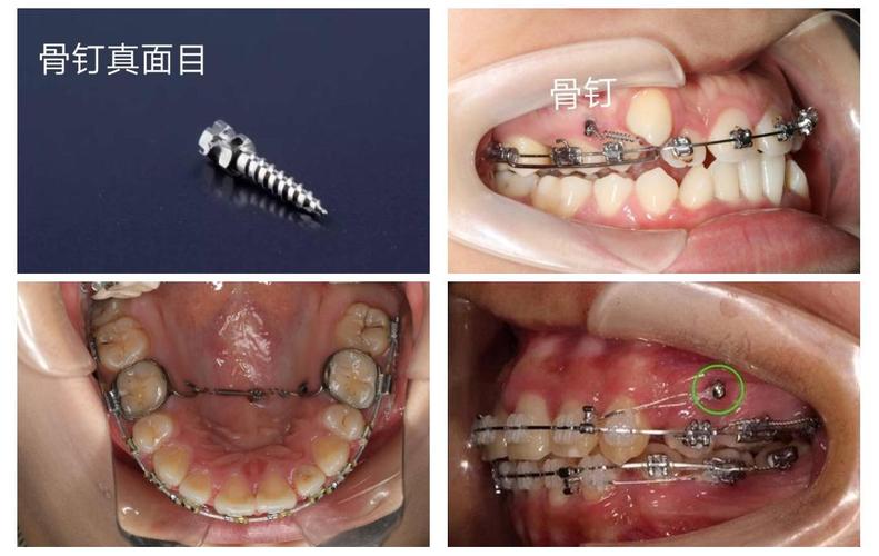 二次正畸必用种植钉吗？作用与风险解析-图3