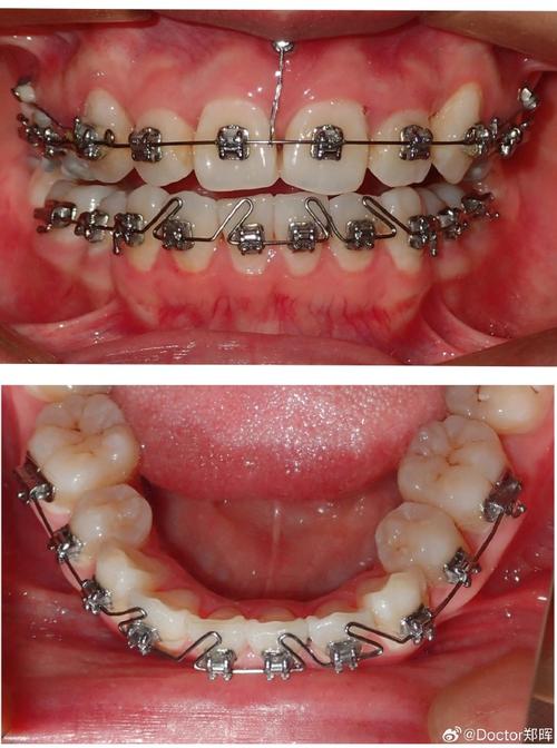 不锈钢丝英寸规格如何影响正畸治疗效果？-图2