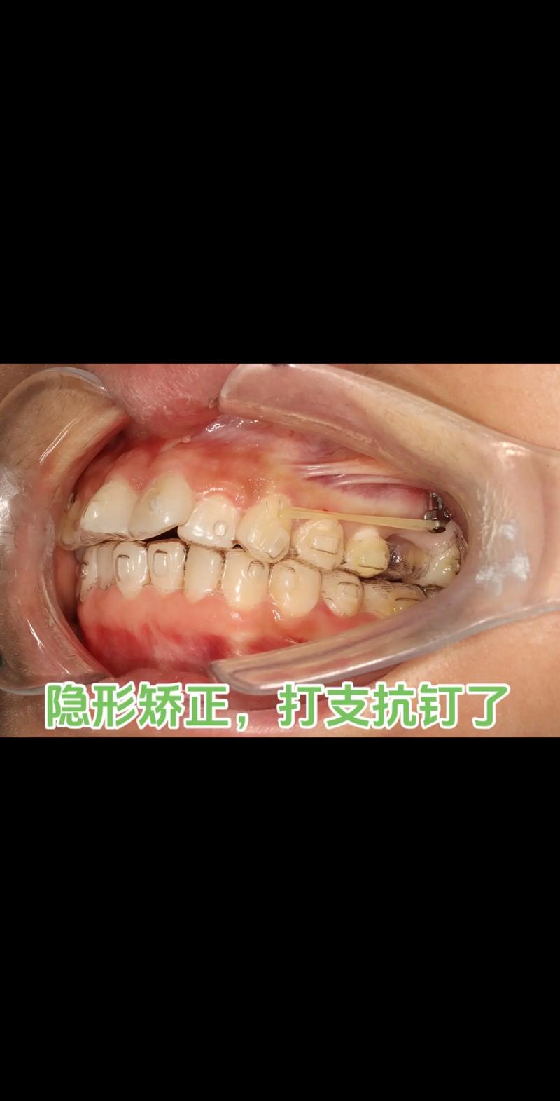 正畸深覆颌支抗钉-图2