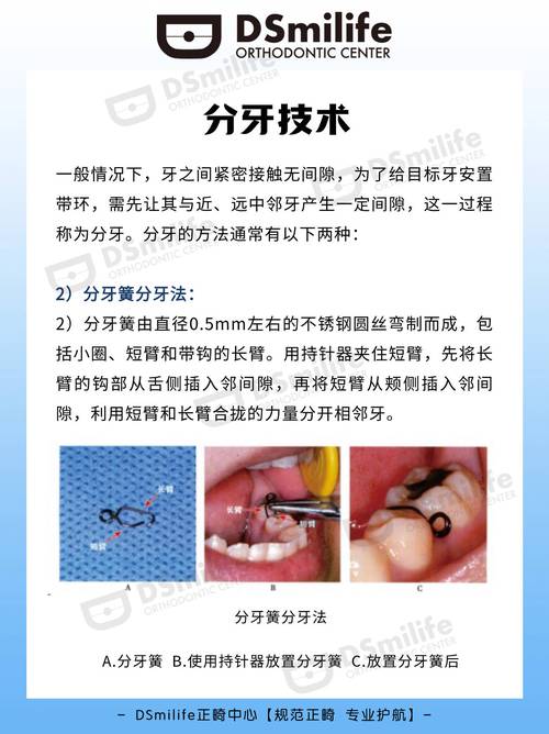 正畸分牙簧怎么上-图1
