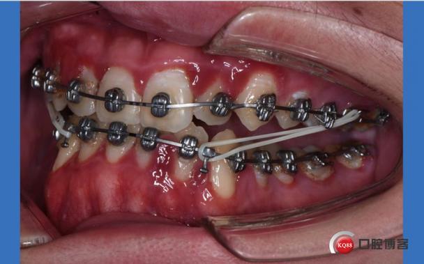 正畸带状弓是什么-图1