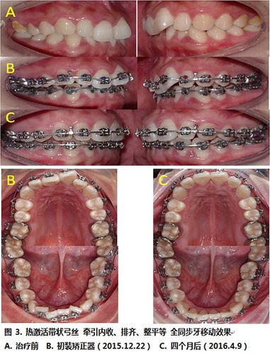 正畸带状弓是什么-图3