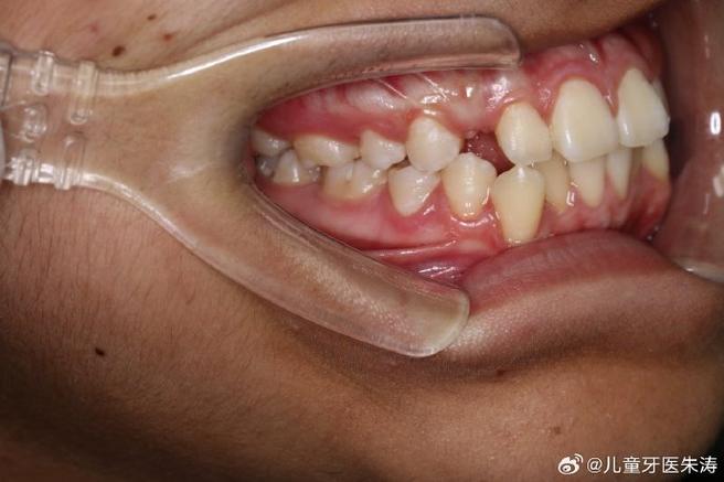 混合牙列正畸检查-图2