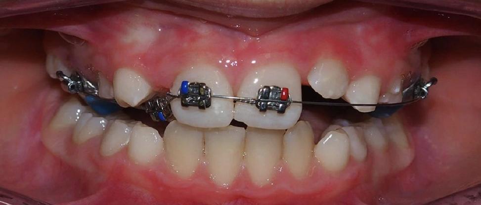 混合牙列正畸检查-图3