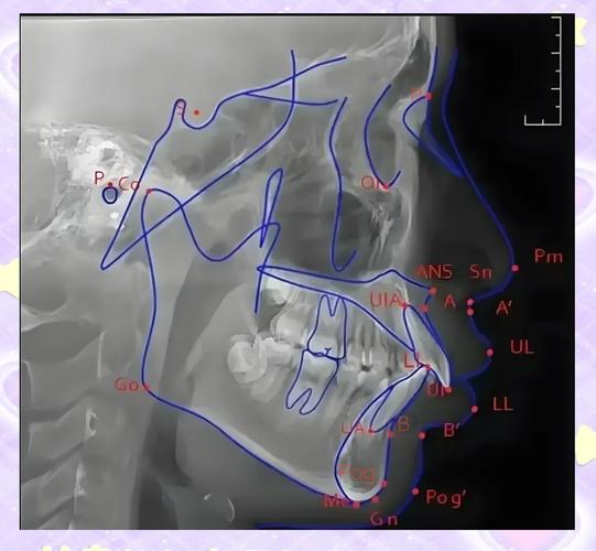 正畸头影测量z角-图1