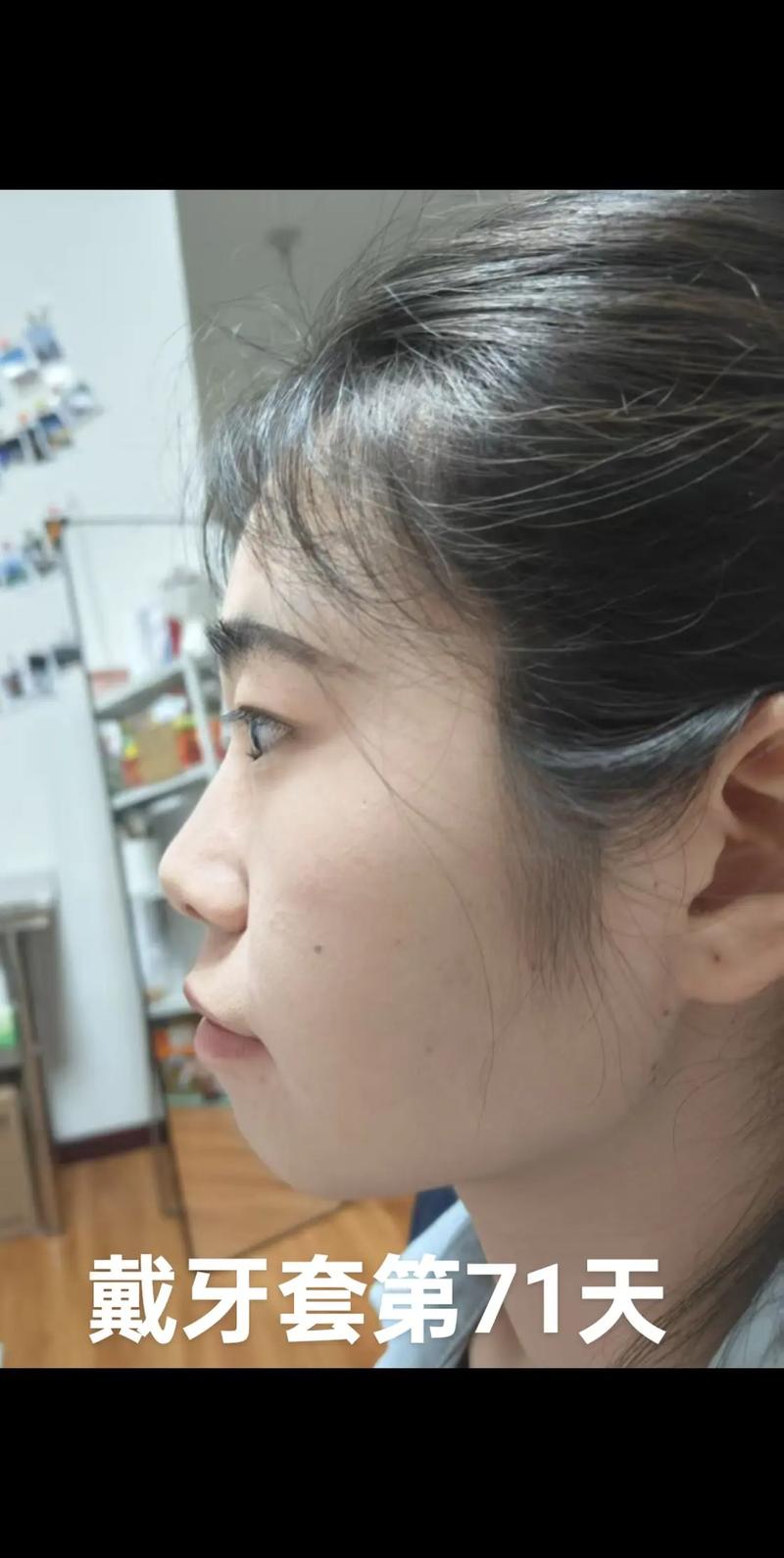 正畸牙改变侧脸图-图1