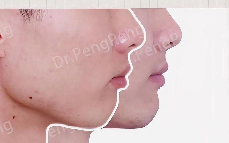 正畸牙改变侧脸图-图2