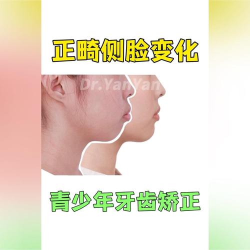 正畸牙改变侧脸图-图3