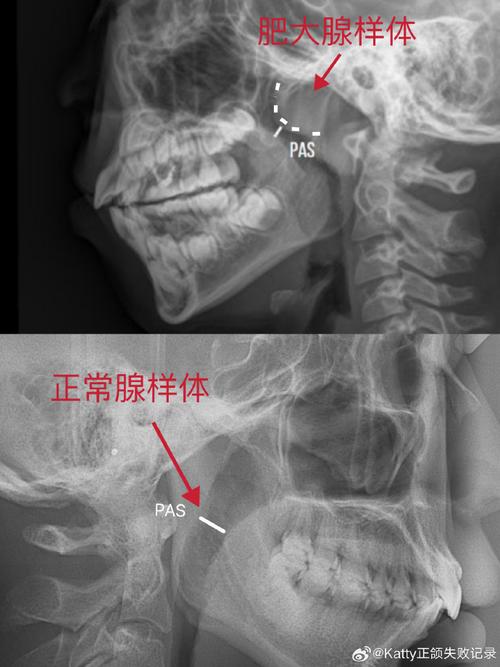 正畸侧位片LI点-图2