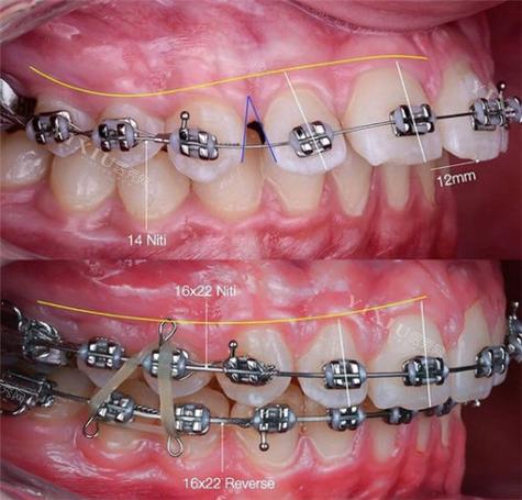 正畸中圣马特托槽-图3