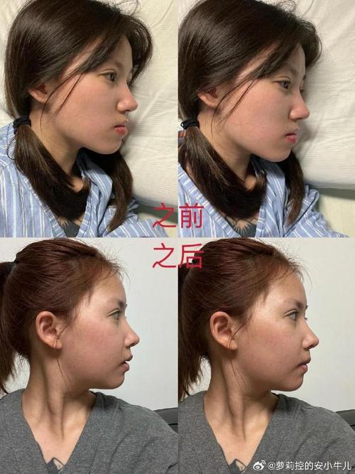 正颌前正畸会变多丑吗？-图3