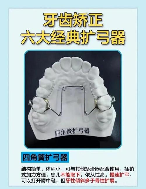 什么是正畸扩工器-图1
